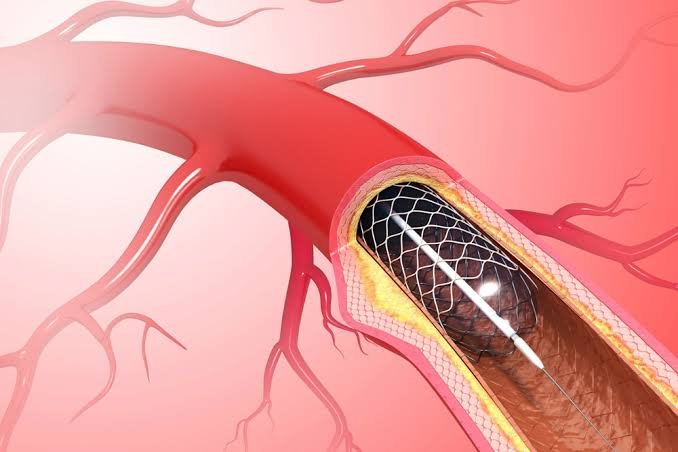 Stent Placement for AV Fistula