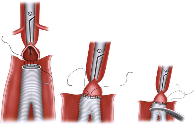 Open Surgical Repair for Aortic Aneurysm