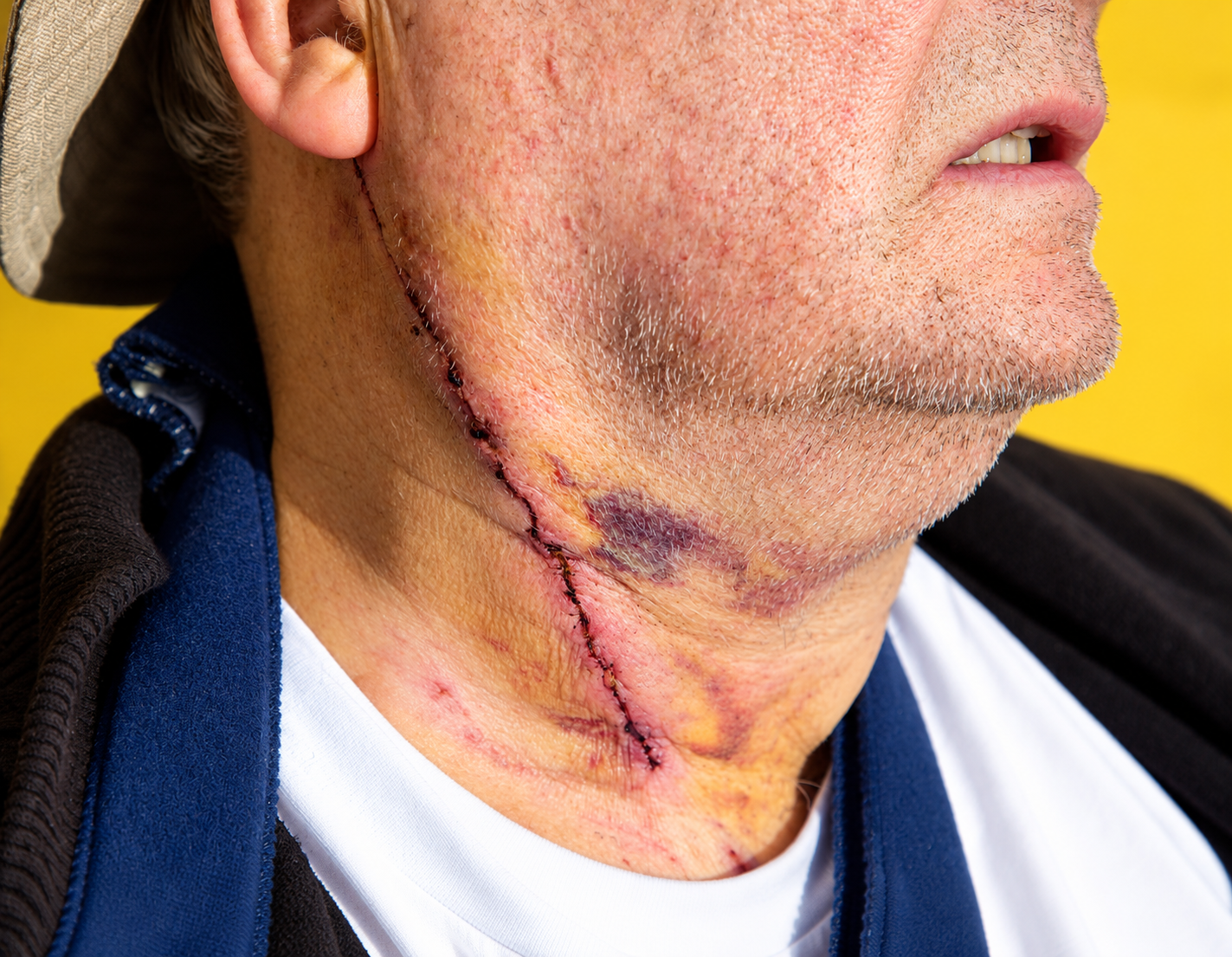 Carotid Endarterectomy for Carotid Artery Disease