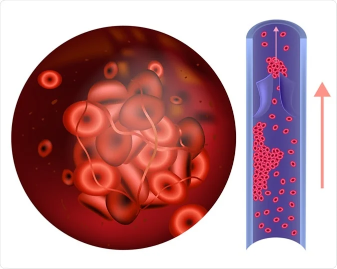 Anticoagulant Medication for Deep Vein Thrombosis