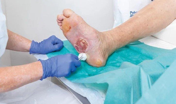 Wound Debridement for diabetic foot care
