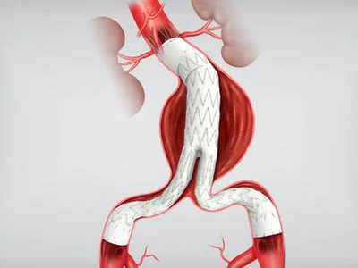 Endovascular Aneurysm Repair EVAR