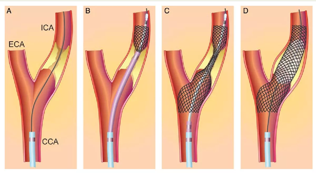 Carotid Artery Stenting for Carotid Artery Disease