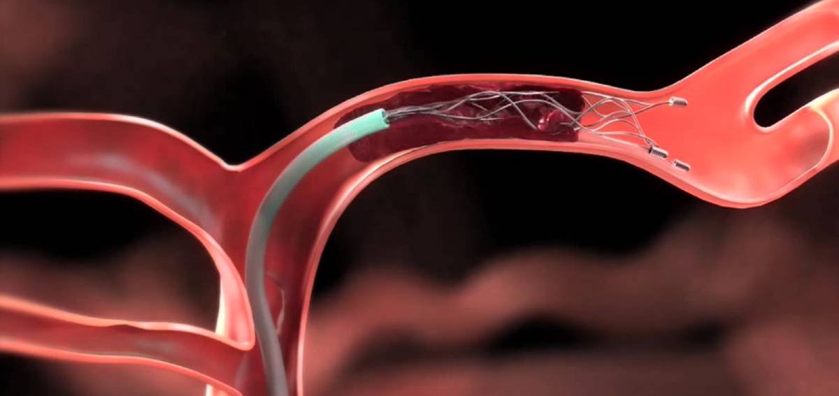 Thrombectomy for AV Fistula