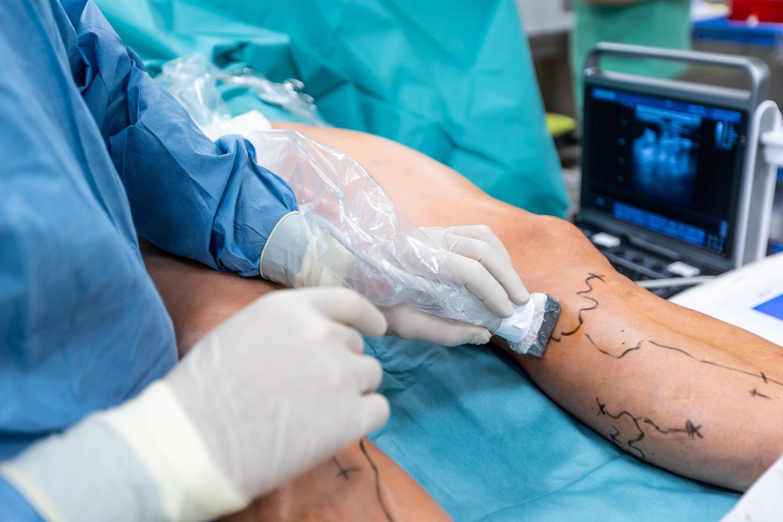 Vascular Surgery for Gangrene