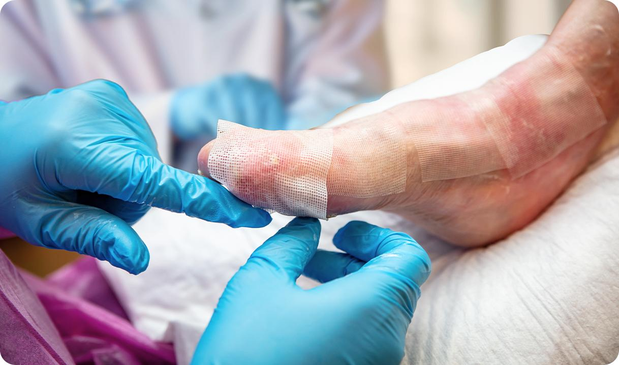 Infection control and wound treatment for diabetic foot
