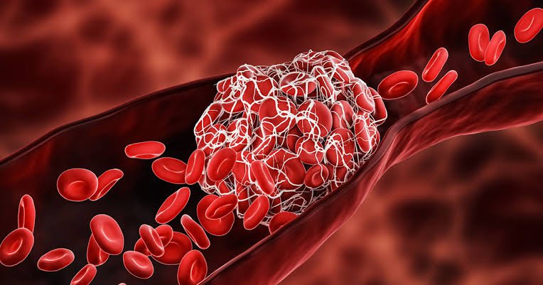 Antiplatelet Therapy for Carotid Artery Disease