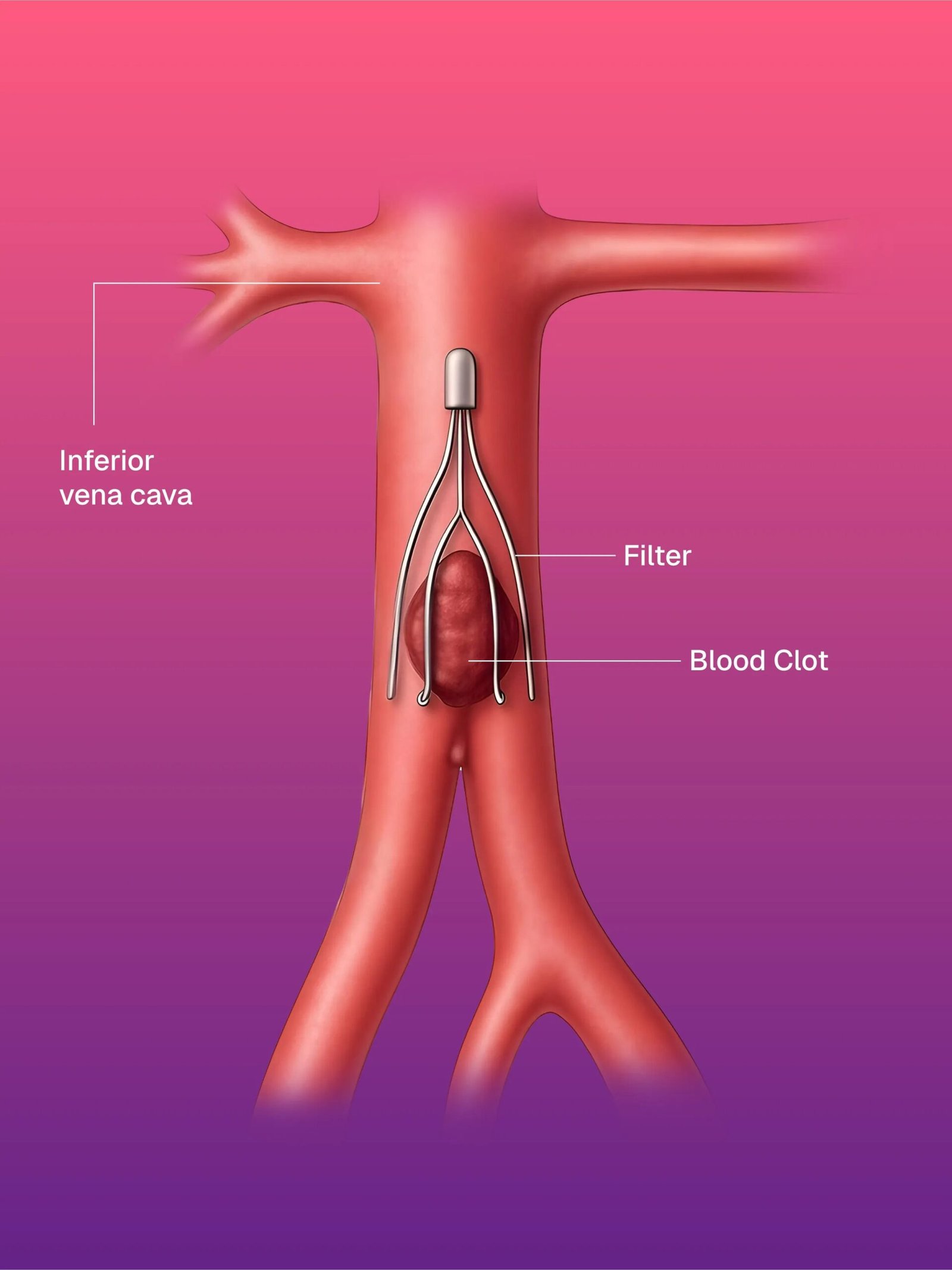 IVC Filter for Deep Vein Thrombosis
