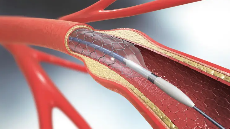 Angioplasty for Peripheral Artery Disease