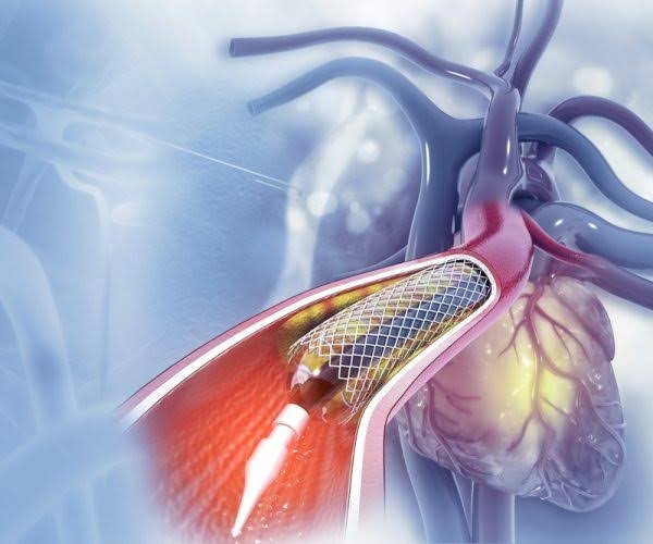 Stenting for Peripheral Artery Disease