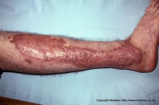 Skin Grafts for Gangrene Wounds