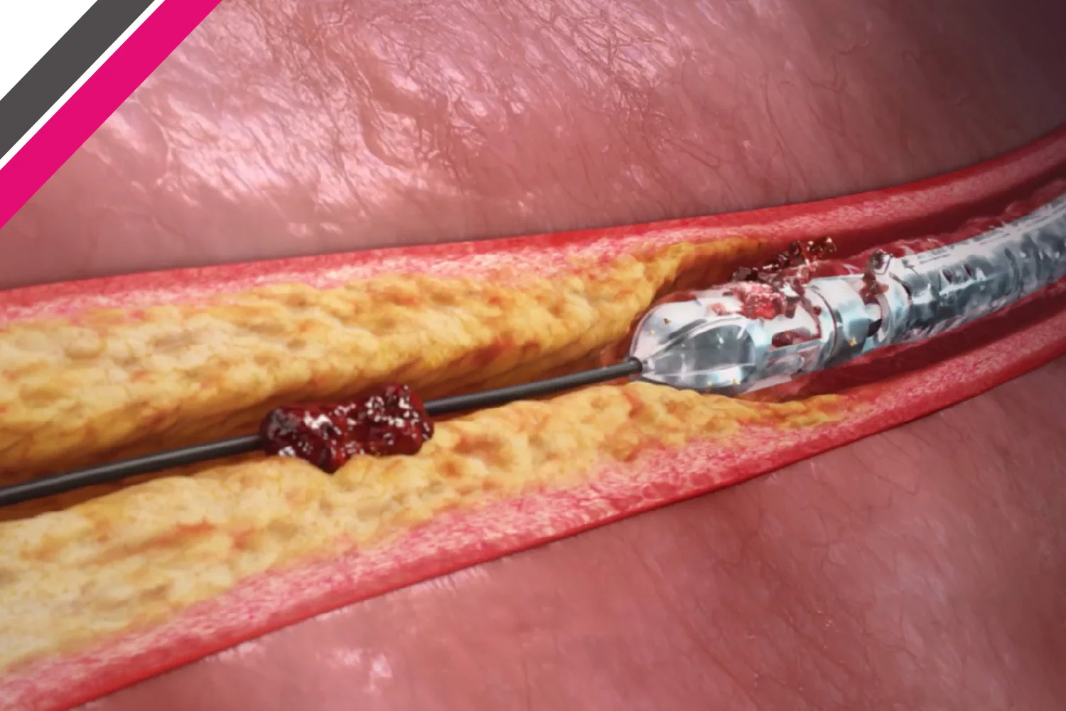 Atherectomy for Peripheral Artery Disease