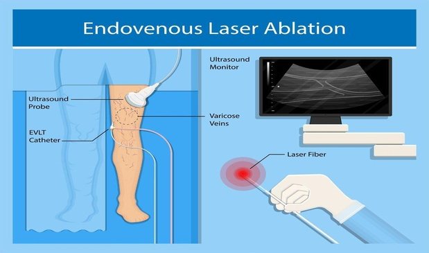 Endovenous Laser Ablation (EVLA)