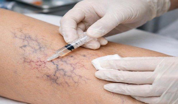 Sclerotherapy