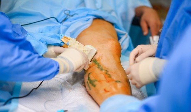Ambulatory Phlebectomy