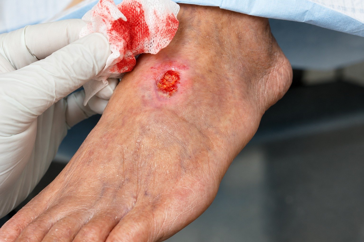 Peripheral Artery Disease