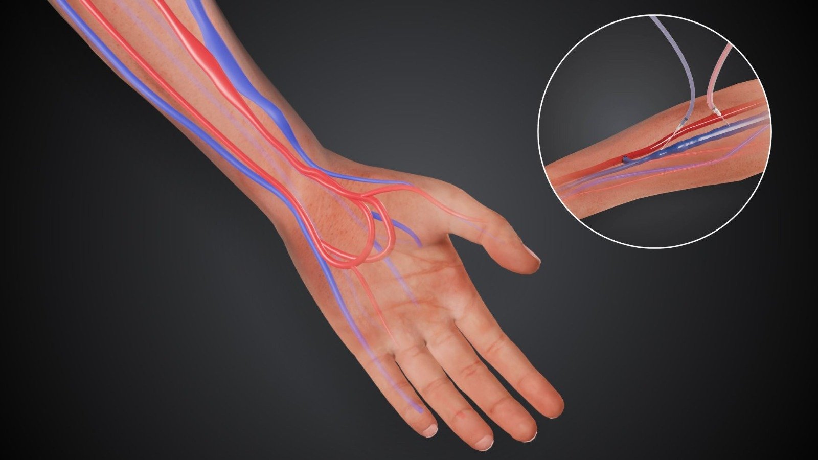 Arteriovenous (AV) Fistula