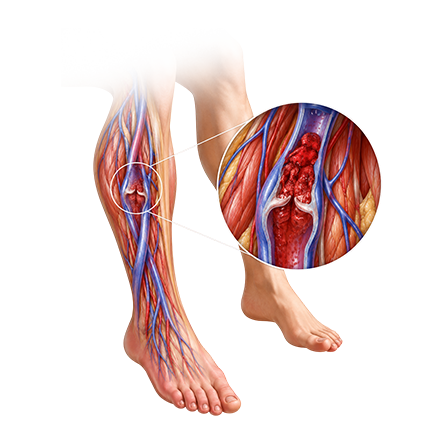 Deep Vein Thrombosis